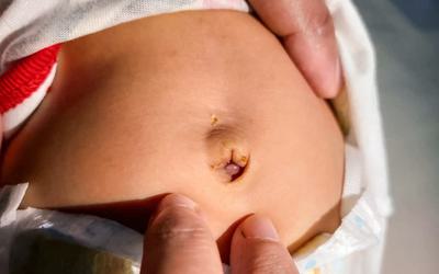 Notícias - Granuloma umbilical: saiba como tratar esta condição nos bebés