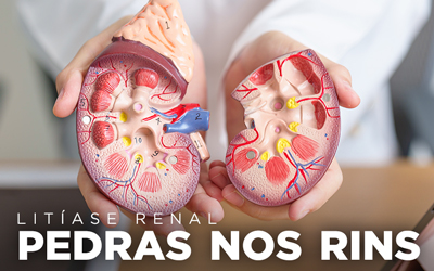 LITÍASE RENAL: PEDRAS NOS RINS LITÍASE RENAL: PEDRAS NOS RINS