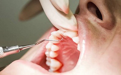 Má higiene dentária aumenta risco de hipertensão
