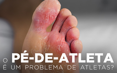 O PÉ DE ATLETA É UM PROBLEMA DE ATLETAS? O PÉ DE ATLETA É UM PROBLEMA DE ATLETAS?