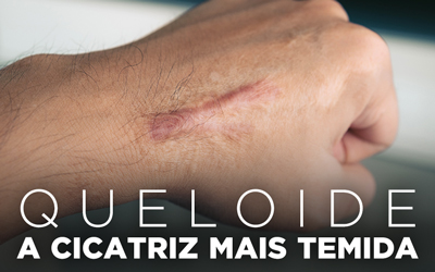 QUELOIDE, A CICATRIZ MAIS TEMIDA QUELOIDE, A CICATRIZ MAIS TEMIDA
