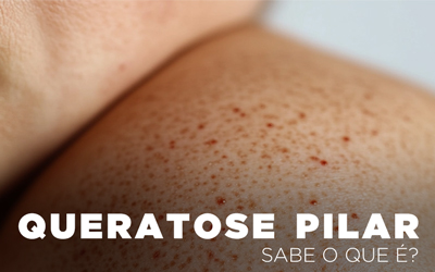 QUERATOSE PILAR, SABE O QUE É? QUERATOSE PILAR, SABE O QUE É?