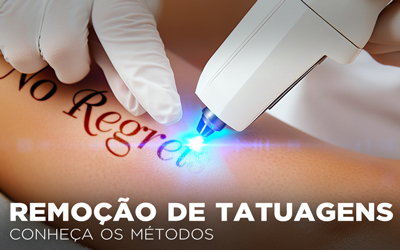 REMOÇÃO DE TATUAGENS, CONHEÇA OS MÉTODOS REMOÇÃO DE TATUAGENS, CONHEÇA OS MÉTODOS