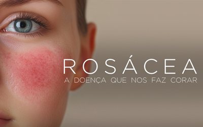 ROSÁCEA: A DOENÇA QUE NOS FAZ CORAR ROSÁCEA: A DOENÇA QUE NOS FAZ CORAR