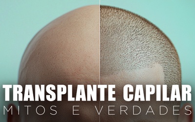 TRANSPLANTE CAPILAR: MITOS E VERDADES TRANSPLANTE CAPILAR: MITOS E VERDADES