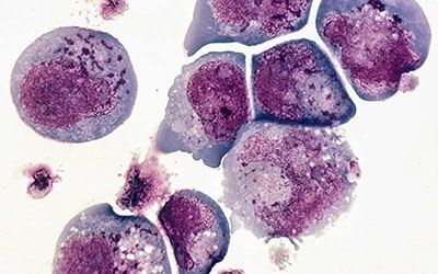 Vírus do herpes tipo 6 associado à esclerose múltipla