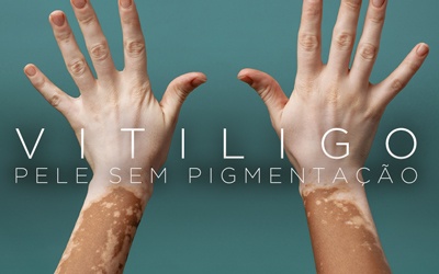 VITILIGO, PELE SEM PIGMENTAÇÃO