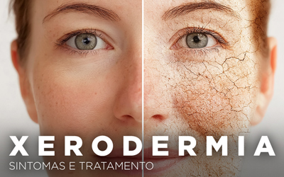 XERODERMIA, SINTOMAS E TRATAMENTO