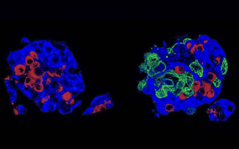 Método inovador no transplante de células produtoras de insulina na diabetes tipo 1