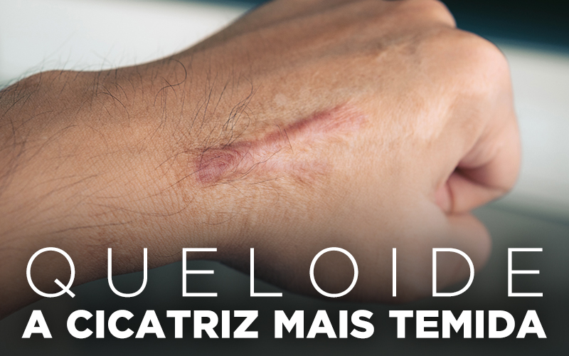 QUELOIDE, A CICATRIZ MAIS TEMIDA QUELOIDE, A CICATRIZ MAIS TEMIDA