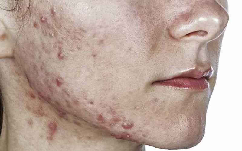 Retinoide de quarta geração revela-se promissor contra acne