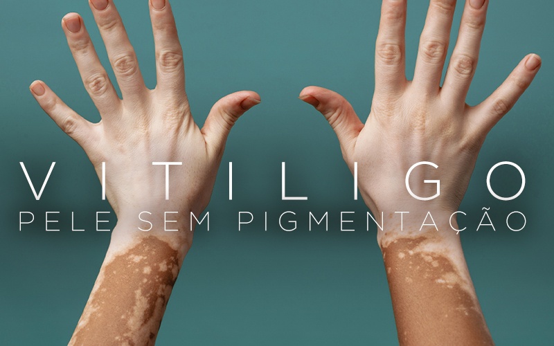 VITILIGO, PELE SEM PIGMENTAÇÃO