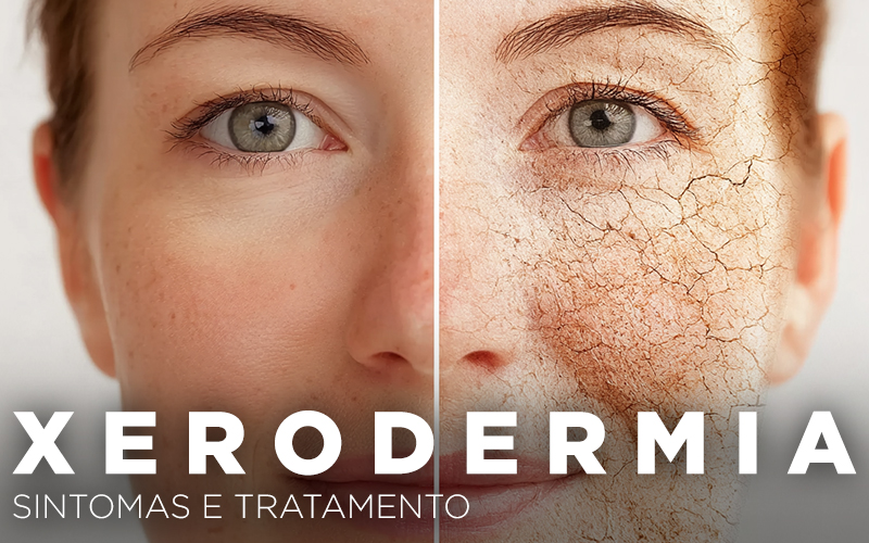 XERODERMIA, SINTOMAS E TRATAMENTO
