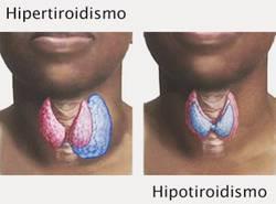 hipertiroidismo hipotiroidismo