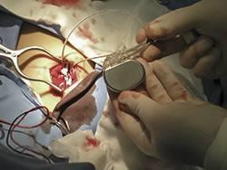 implante de pacemaker