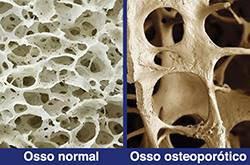 osso osteoporótico