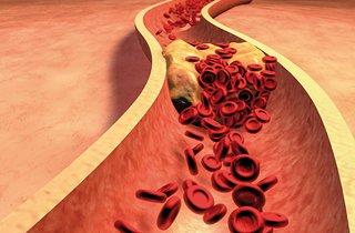 colesterol na arteria