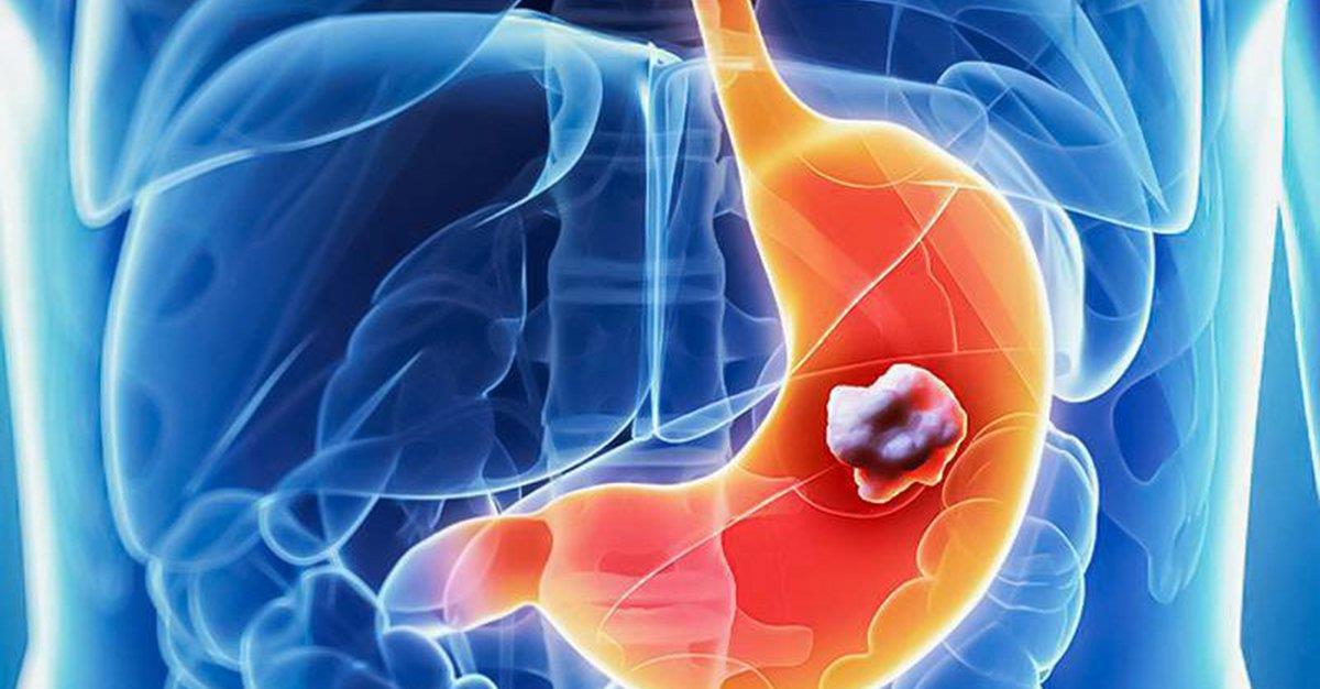 Cancro digestivo mata uma pessoa por hora em Portugal
