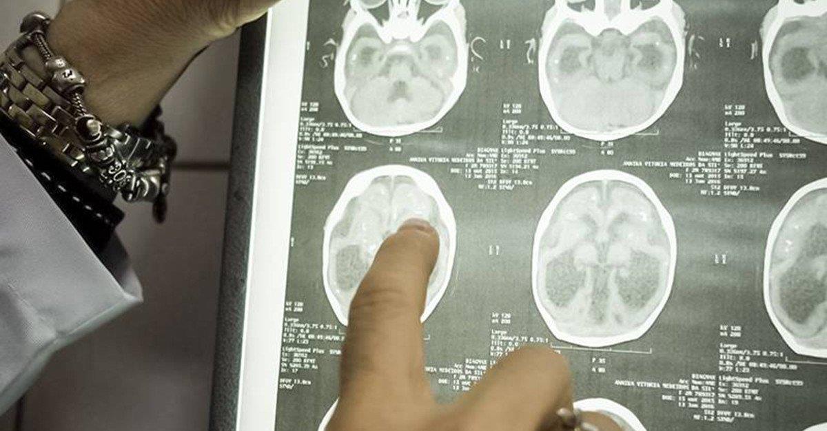 Vírus Zika eficaz contra células de cancro cerebral em adultos
