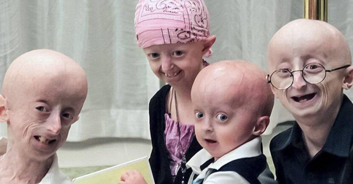 Terapia com inibidor da farnesiltransferase aumenta sobrevida de crianças com progeria