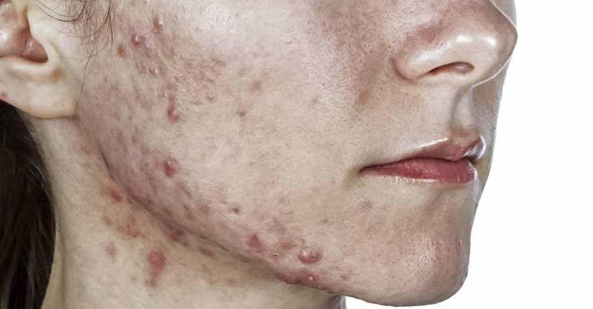 Retinoide de quarta geração revela-se promissor contra acne
