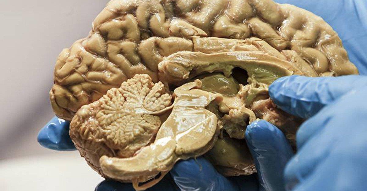 Cientistas descobrem nova estratégia de combate ao Alzheimer