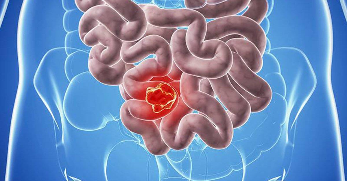 Cancro do intestino afeta 370 mil europeus