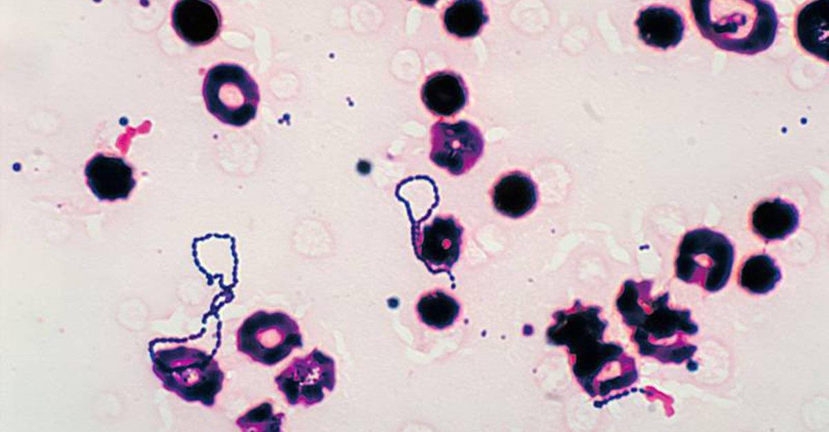 Identificadas bactérias orais em êmbolos cerebrais de pacientes vítimas de AVC