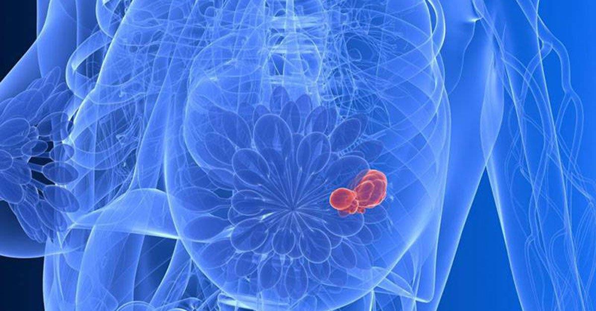 Eletromagnetismo impede disseminação de células do cancro da mama