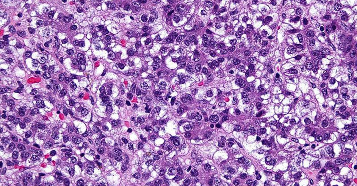 Gene de cancro da mama também pode causar hepatoblastoma