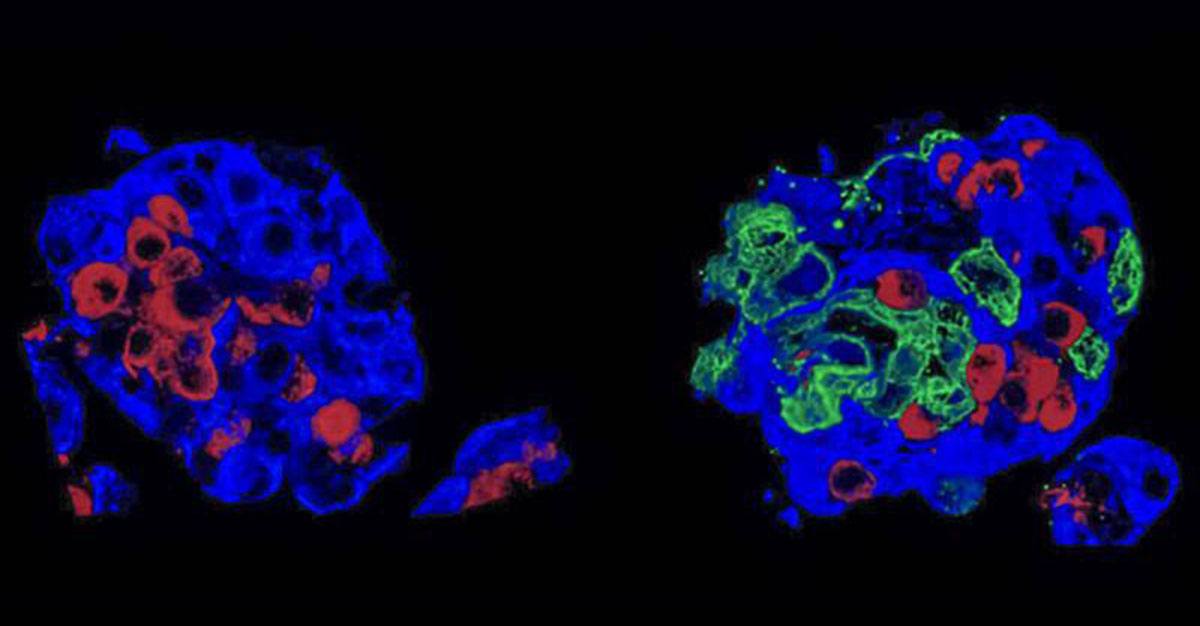 Método inovador no transplante de células produtoras de insulina na diabetes tipo 1