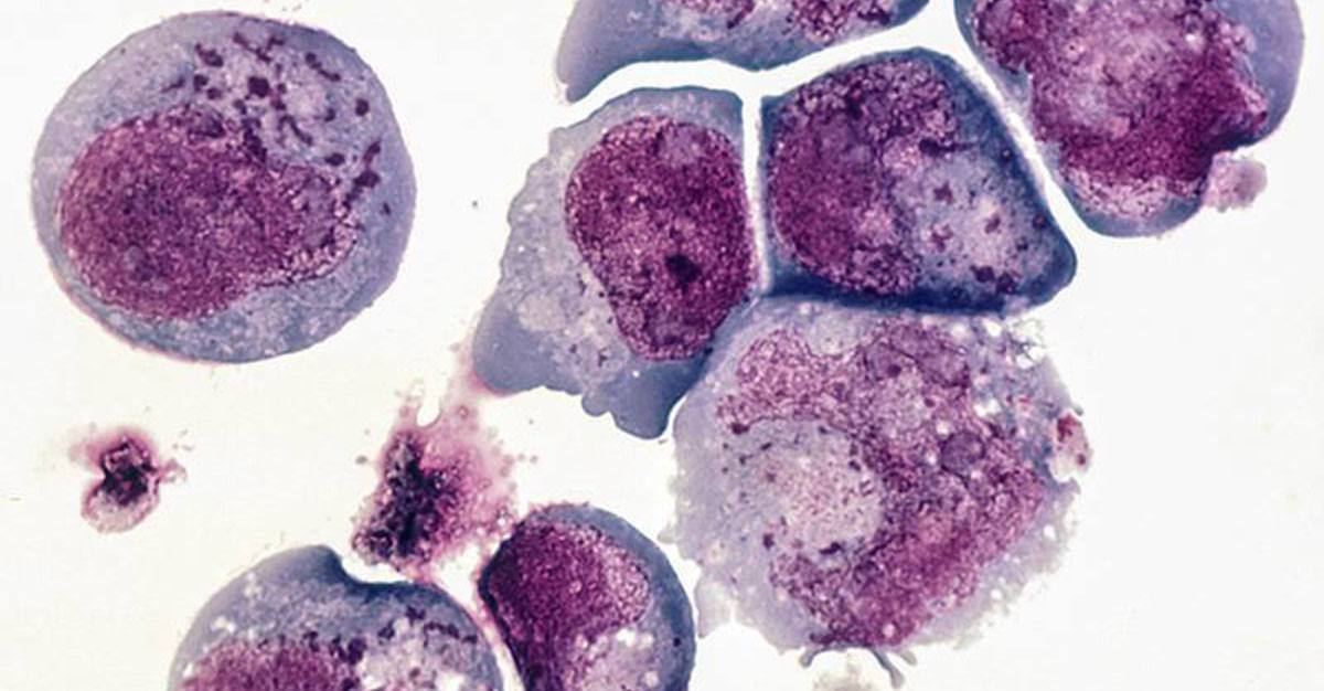 Vírus do herpes tipo 6 associado à esclerose múltipla