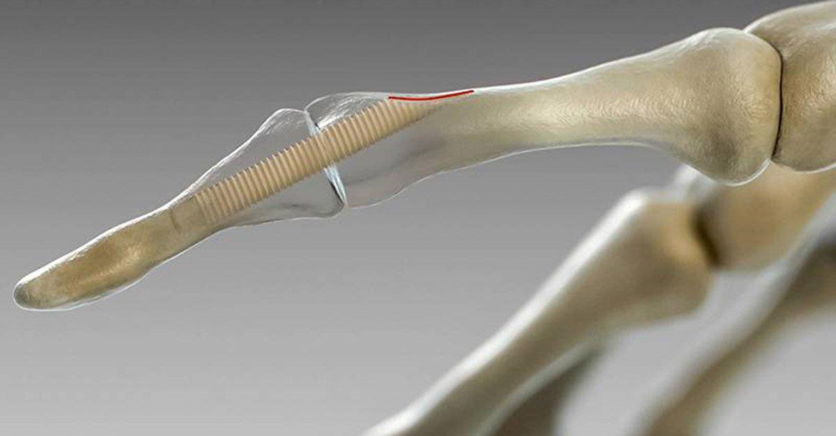 Parafusos ósseos mais eficazes  em cirurgias ortopédicas