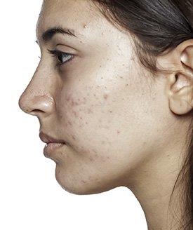 Mulher com acne