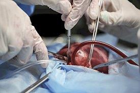 Transplante de órgãos