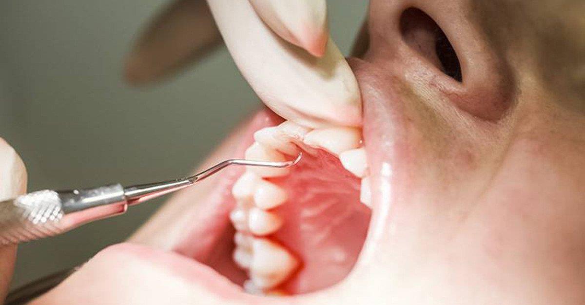Má higiene dentária aumenta risco de hipertensão