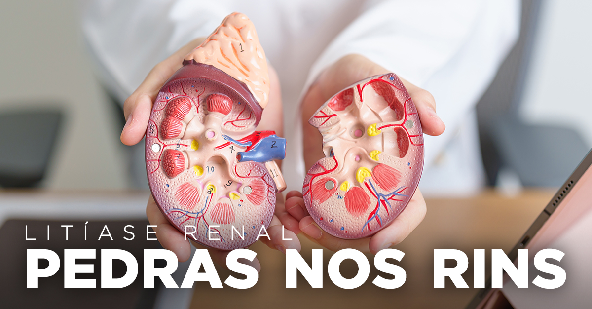 LITÍASE RENAL: PEDRAS NOS RINS LITÍASE RENAL: PEDRAS NOS RINS
