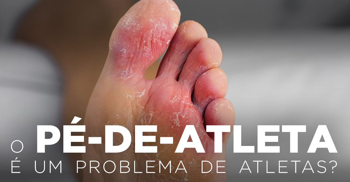 O PÉ DE ATLETA É UM PROBLEMA DE ATLETAS? O PÉ DE ATLETA É UM PROBLEMA DE ATLETAS?