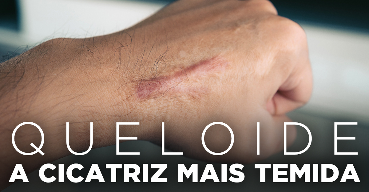 Artigos - QUELOIDE, A CICATRIZ MAIS TEMIDA