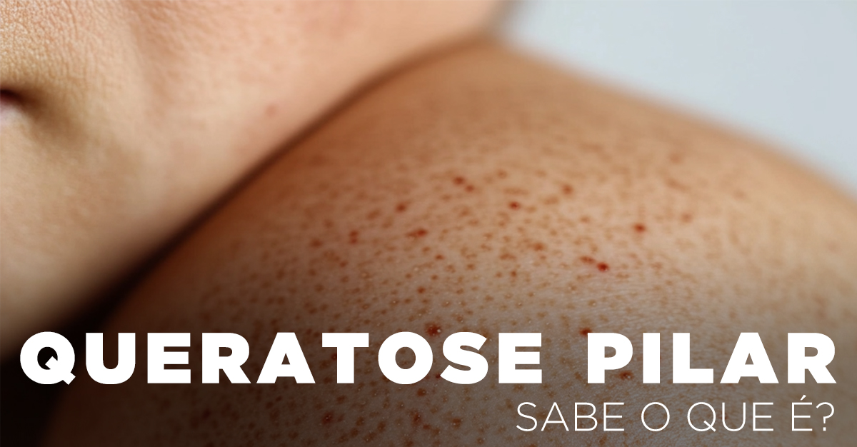 Artigos - QUERATOSE PILAR, SABE O QUE É?