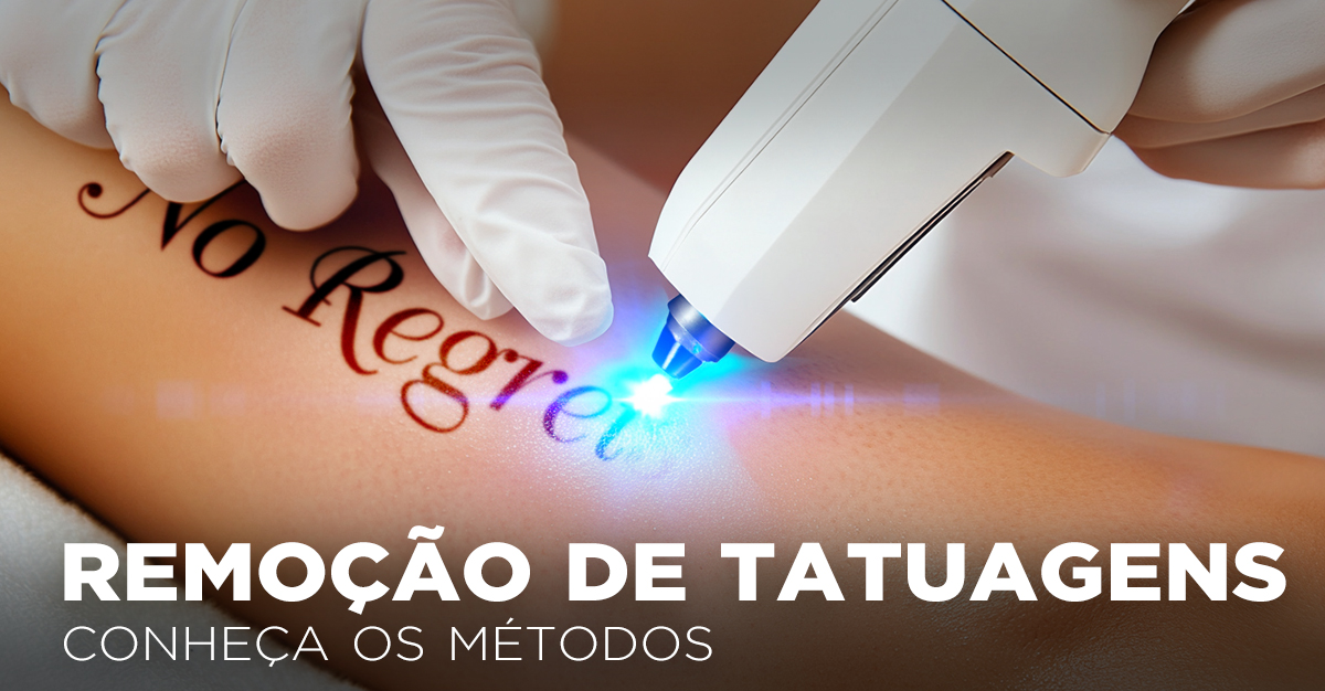 REMOÇÃO DE TATUAGENS, CONHEÇA OS MÉTODOS