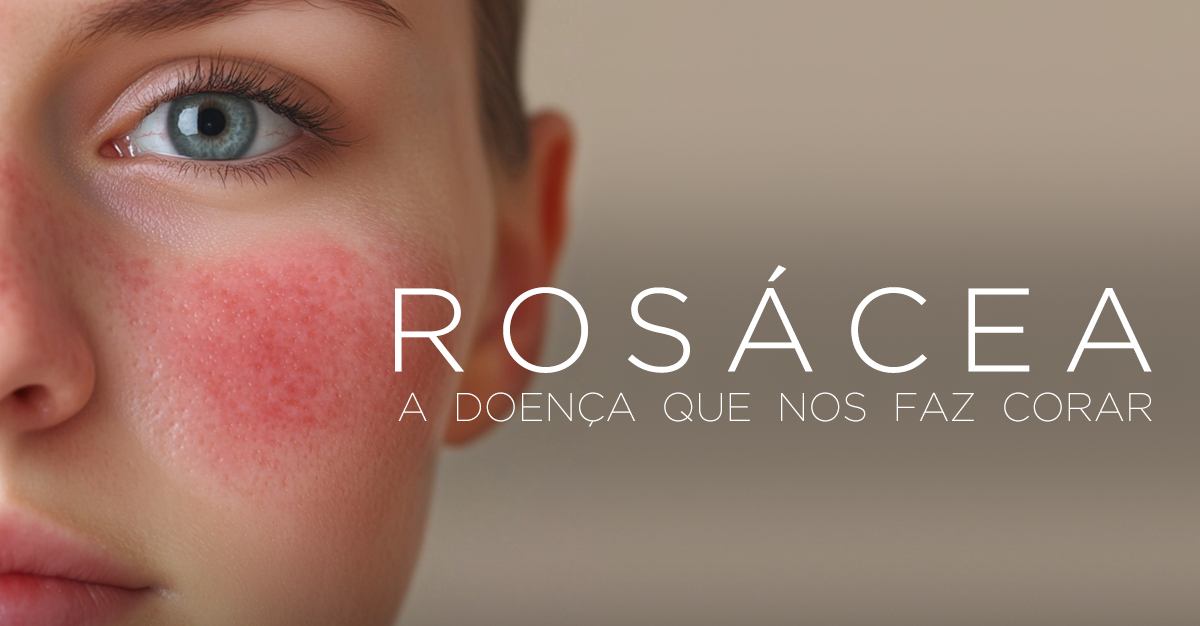 ROSÁCEA: A DOENÇA QUE NOS FAZ CORAR ROSÁCEA: A DOENÇA QUE NOS FAZ CORAR