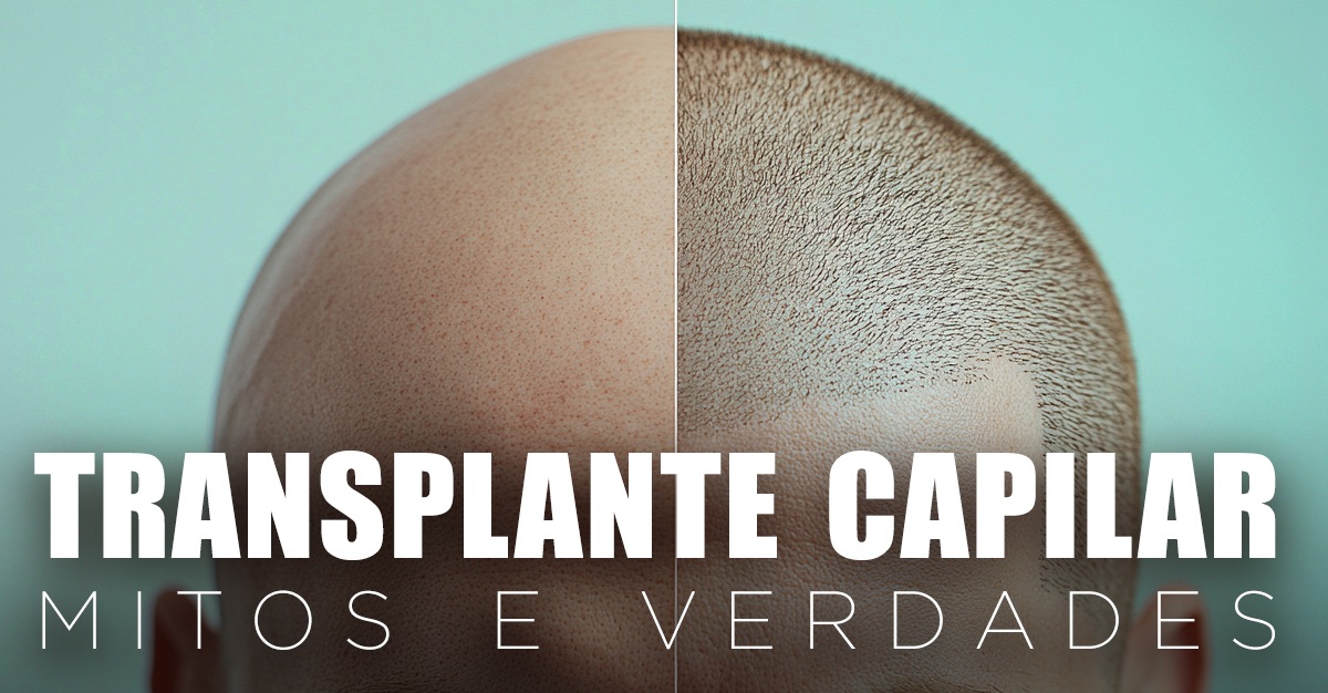 TRANSPLANTE CAPILAR: MITOS E VERDADES TRANSPLANTE CAPILAR: MITOS E VERDADES