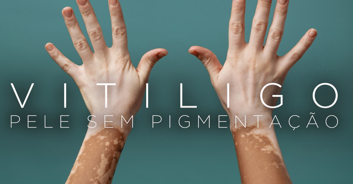 Artigos - VITILIGO, PELE SEM PIGMENTAÇÃO