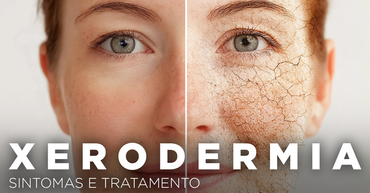 Artigos - XERODERMIA, SINTOMAS E TRATAMENTO