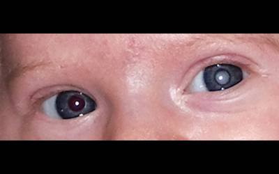 Catarata congénita é a principal causa de cegueira na infância