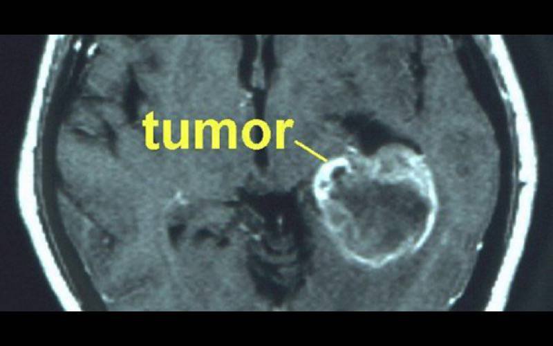 Fusão de células normais pode dar origem a tumores cancerígenos