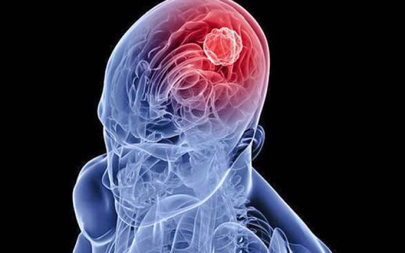 Laser deteta células tumorais do cérebro durante cirurgia