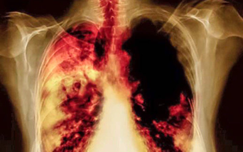 FDA aprova Portrazza para tratar tipo de Cancro do Pulmão