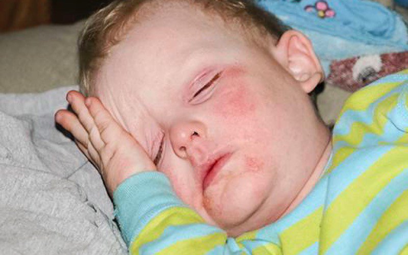 Melatonina pode ajudar Crianças com Eczema a Dormir Melhor